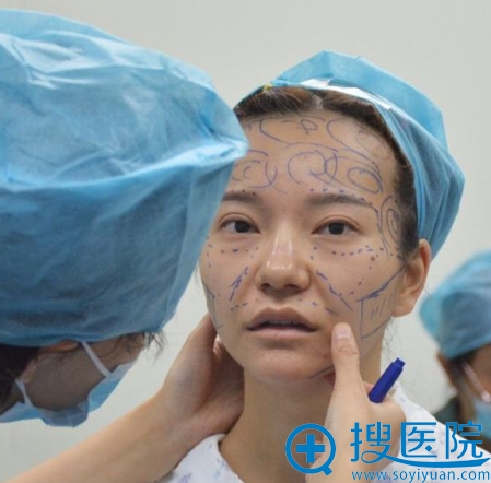 杭州瑞丽整形医院何涛脂肪填充画线过程 杭州瑞丽整形医院何涛脂肪填充画线过程