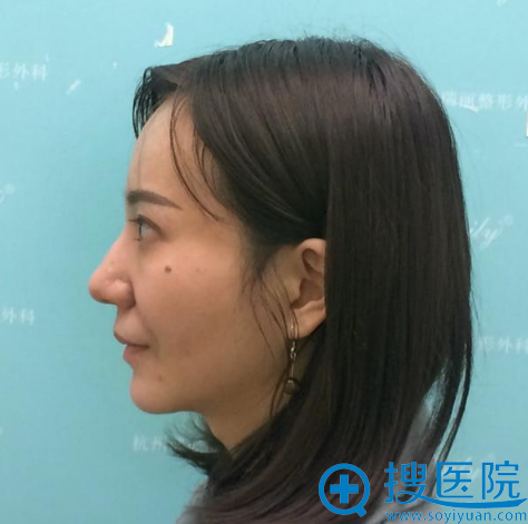 之前在杭州瑞丽做了双眼皮和垫下巴这次又来做了自体脂肪填充