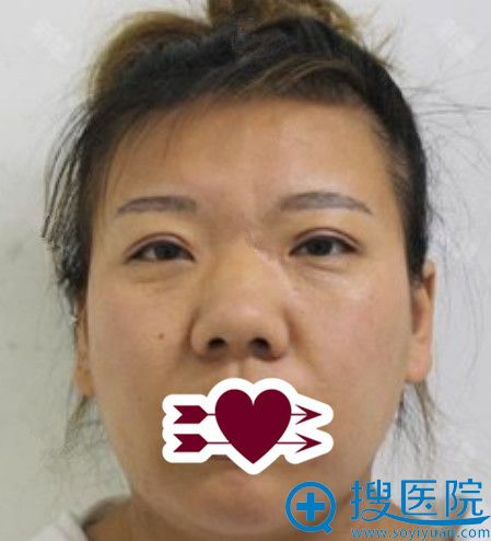 我找郑州芳艺杨伟做鼻综合+下巴抽脂是在了解集美陈曦的价格后