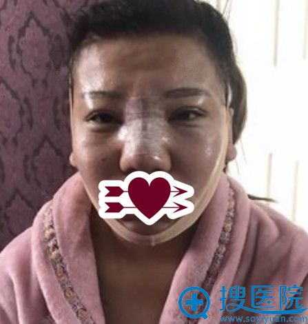 让郑州芳艺整形杨伟做鼻综合+下巴吸脂术后即刻照 让郑州芳艺整形杨伟做鼻综合+下巴吸脂术后即刻照