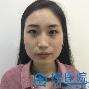 在武汉美仑做了面部吸脂瘦脸后大家都说我与之前判若两人
