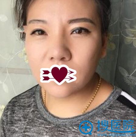 郑州芳艺整形综合隆鼻+下巴吸脂术后第8天恢复情况 郑州芳艺整形综合隆鼻+下巴吸脂术后第8天恢复情况