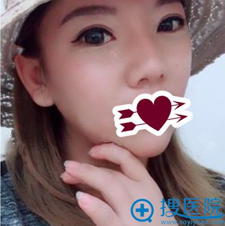 杨伟下巴吸脂+鼻综合第56天效果图 杨伟下巴吸脂+鼻综合第56天效果图