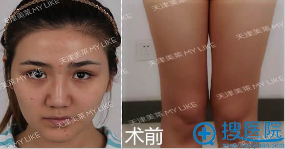 我于3月6日去天津美莱做了多维立体大腿吸脂及全脸自体脂肪填充