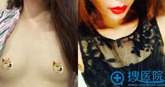 趁今天有时间我给大家分享找遵义韩美王军做自体脂肪丰胸经历