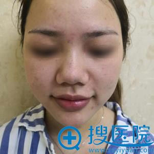鼻子对颜值的影响有多大?看我找成都西区肖凌做的鼻综合效果吧