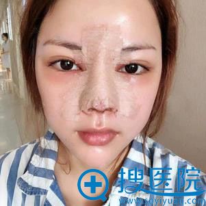 成都西区医院肖凌鼻综合案例 成都西区医院肖凌鼻综合案例