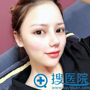 成都西区医院肖凌鼻综合案例 成都西区医院肖凌鼻综合案例