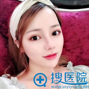 成都西区医院肖凌鼻综合案例 成都西区医院肖凌鼻综合案例