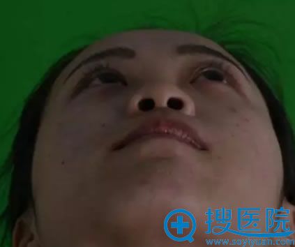 今年终于在包头时光整形医院完成了假体隆鼻手术,效果挺自然的
