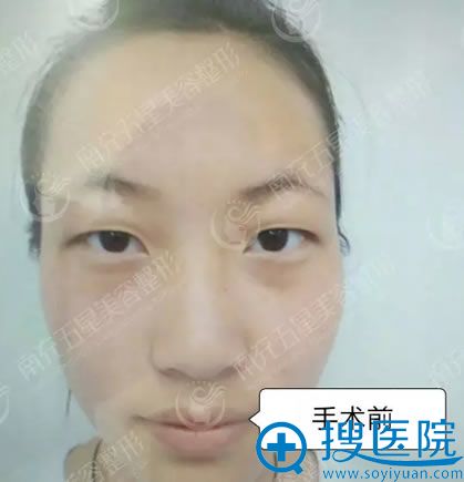 决定公开秀一下这次找南充五星刘新一做双眼皮和开眼角的效果