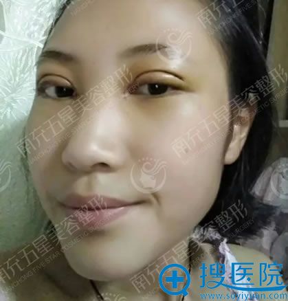 在南充五星做完双眼皮2天后 在南充五星做完双眼皮2天后