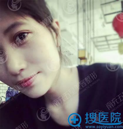 找南充五星刘新一做双眼皮效果 找南充五星刘新一做双眼皮效果