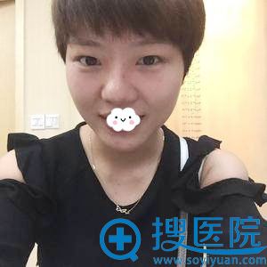 <!--<i data=20240710 data-id=12610></i>-->张化博埋线双眼皮真人案例 <!--<i data=20240710 data-id=12610></i>-->张化博埋线双眼皮真人案例