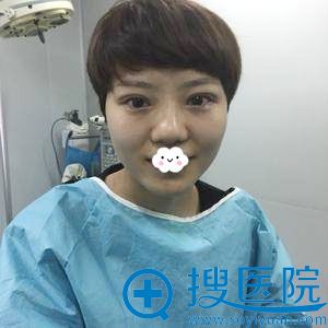 <!--<i data=20240710 data-id=12610></i>-->双眼皮效果怎么样?张化博埋线双眼皮案例 <!--<i data=20240710 data-id=12610></i>-->双眼皮效果怎么样?张化博埋线双眼皮案例