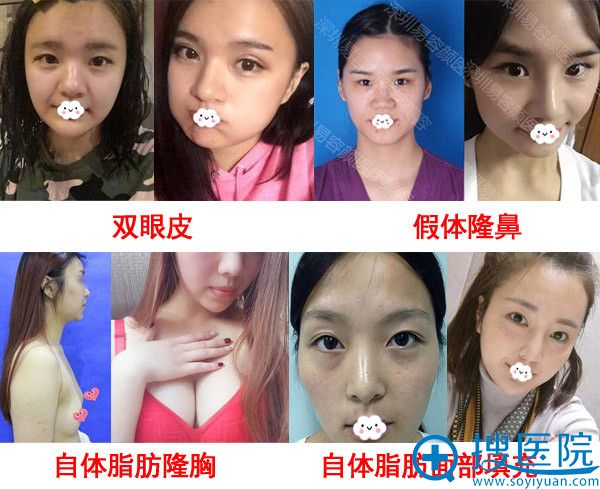 <!--<i data=20240710 data-id=8422></i>-->双眼皮隆胸隆鼻真人案例效果对比 <!--<i data=20240710 data-id=8422></i>-->双眼皮隆胸隆鼻真人案例效果对比