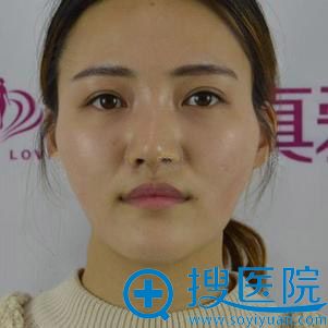 专门从贵阳到长沙真爱找李瑶做了面部脂肪填充,看看效果如何?