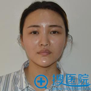 <!--<i data=20240710 data-id=12011></i>-->自体脂肪面部填充案例 <!--<i data=20240710 data-id=12011></i>-->自体脂肪面部填充案例