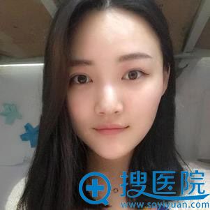 <!--<i data=20240710 data-id=12011></i>-->自体脂肪面部填充案例 <!--<i data=20240710 data-id=12011></i>-->自体脂肪面部填充案例