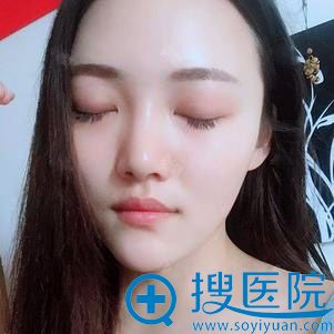 <!--<i data=20240710 data-id=12011></i>-->自体脂肪面部填充案例 <!--<i data=20240710 data-id=12011></i>-->自体脂肪面部填充案例