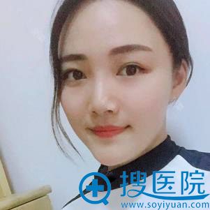 <!--<i data=20240710 data-id=12011></i>-->自体脂肪面部填充案例 <!--<i data=20240710 data-id=12011></i>-->自体脂肪面部填充案例