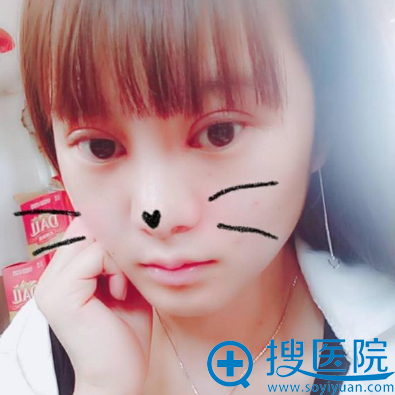 找济南海峡院长全切双眼皮开眼角案例术后7天 找济南海峡院长全切双眼皮开眼角案例术后7天