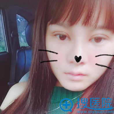 找济南海峡院长做完双眼皮术后一个月 找济南海峡院长做完双眼皮术后一个月