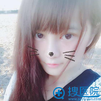 济南历下宝琳娜原济南海峡院长双眼皮案例 济南历下宝琳娜原济南海峡院长双眼皮案例