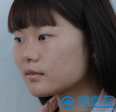 济南历下宝琳娜整形医院双眼皮案例术前 济南历下宝琳娜整形医院双眼皮案例术前