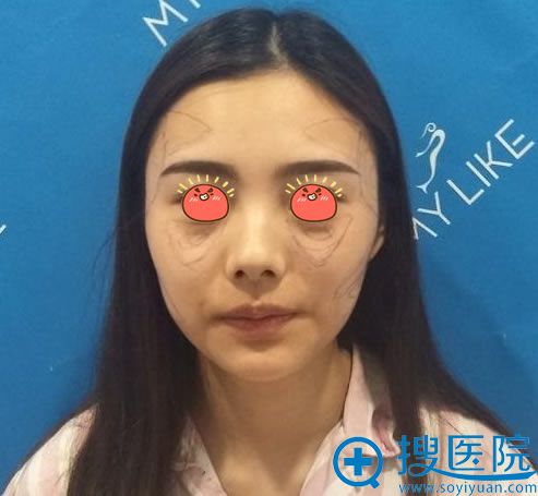 打过玻尿酸这次决定让武汉美莱卓田做大腿抽脂和自体脂肪填充