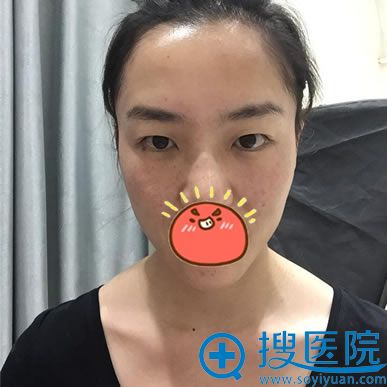 看了昆明华美美莱杨继红和李韬案例选择杨继红做双眼皮开眼角