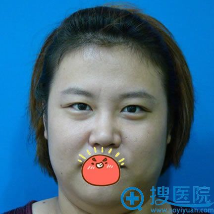 在淄博阳光整形工作8年终于鼓足勇气找杜学莹做双眼皮和隆鼻
