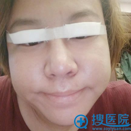 <!--<i data=20240710 data-id=12293></i>-->刚做隆鼻和双眼皮照片 <!--<i data=20240710 data-id=12293></i>-->刚做隆鼻和双眼皮照片