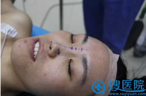 看朋友在保定华美做的双眼皮不错我也来找李斌做了鼻综合隆鼻