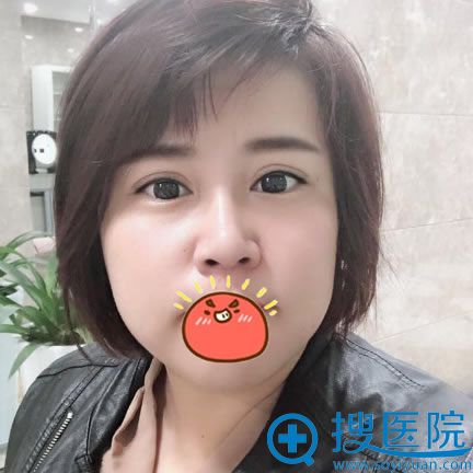<!--<i data=20240710 data-id=12293></i>-->做隆鼻和双眼皮4个月后 <!--<i data=20240710 data-id=12293></i>-->做隆鼻和双眼皮4个月后