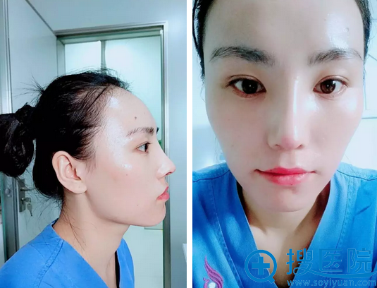 <!--<i data=20240710 data-id=12335></i>-->整形医院李斌隆鼻术后十天 <!--<i data=20240710 data-id=12335></i>-->整形医院李斌隆鼻术后十天