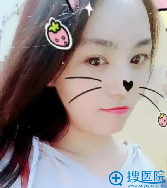<!--<i data=20240710 data-id=12335></i>-->整形医院李斌肋软骨隆鼻案例半个月 <!--<i data=20240710 data-id=12335></i>-->整形医院李斌肋软骨隆鼻案例半个月