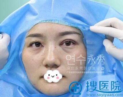 深圳韩国永秀双眼皮效果怎么样? 深圳韩国永秀双眼皮效果怎么样?