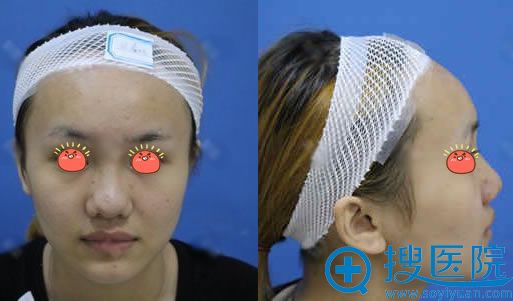 在桂林华美、时光和星范之间我选择华美游海峰做了鼻综合隆鼻