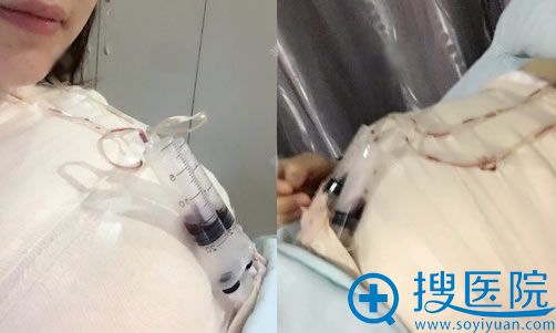 在重庆华美刚做完隆胸照片 在重庆华美刚做完隆胸照片