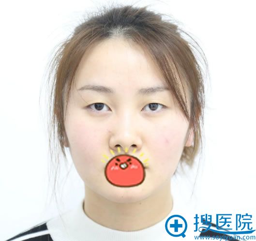 去咨询北京华韩谢立宁觉得挺专业的就让谢立宁做了8mm双眼皮