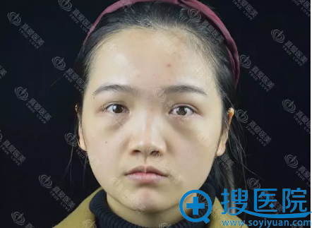 面诊了长沙真爱和三和整形医院后找黄志鹏做了隆鼻和脂肪填充