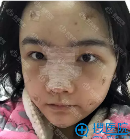 <!--<i data=20240710 data-id=12011></i>-->隆鼻和脂肪填充术后7天 <!--<i data=20240710 data-id=12011></i>-->隆鼻和脂肪填充术后7天