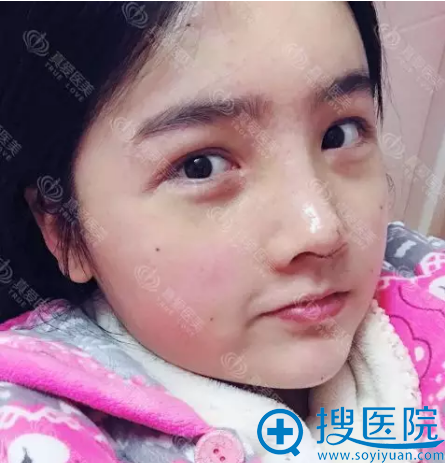 <!--<i data=20240710 data-id=12011></i>-->隆鼻和脂肪填充术后15天 <!--<i data=20240710 data-id=12011></i>-->隆鼻和脂肪填充术后15天