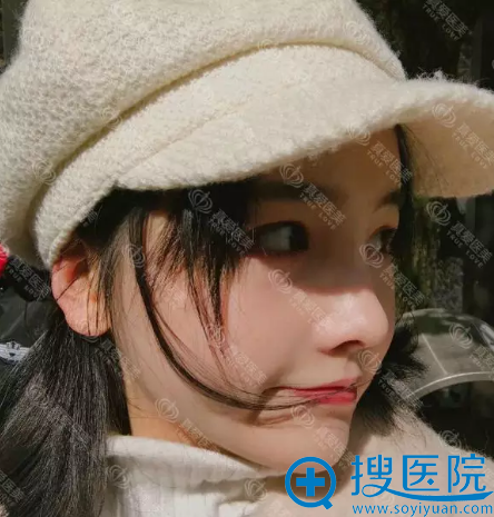 <!--<i data=20240710 data-id=12011></i>-->黄志鹏隆鼻和李瑶自体脂肪填充案例术后 <!--<i data=20240710 data-id=12011></i>-->黄志鹏隆鼻和李瑶自体脂肪填充案例术后
