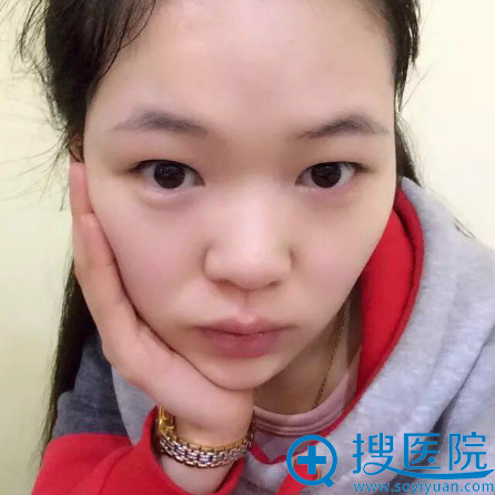 看上海百达丽徐晓婓做的眼睛案例很好看于是我慕名来做了双眼皮