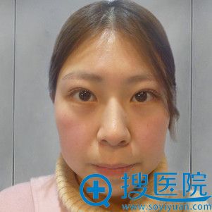 分享我在合肥新地找崔劲松院长做假体下巴+面部吸脂改脸型效果