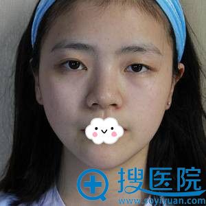 <!--<i data=20240710 data-id=11954></i>-->全切双眼皮+开眼角+上睑下至真人案例 <!--<i data=20240710 data-id=11954></i>-->全切双眼皮+开眼角+上睑下至真人案例
