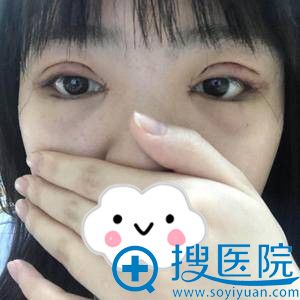 <!--<i data=20240710 data-id=11954></i>-->全切双眼皮+开眼角效果怎么样 <!--<i data=20240710 data-id=11954></i>-->全切双眼皮+开眼角效果怎么样