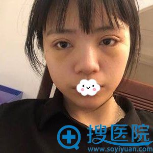 <!--<i data=20240710 data-id=11954></i>-->眼综合术后恢复效果图 <!--<i data=20240710 data-id=11954></i>-->眼综合术后恢复效果图